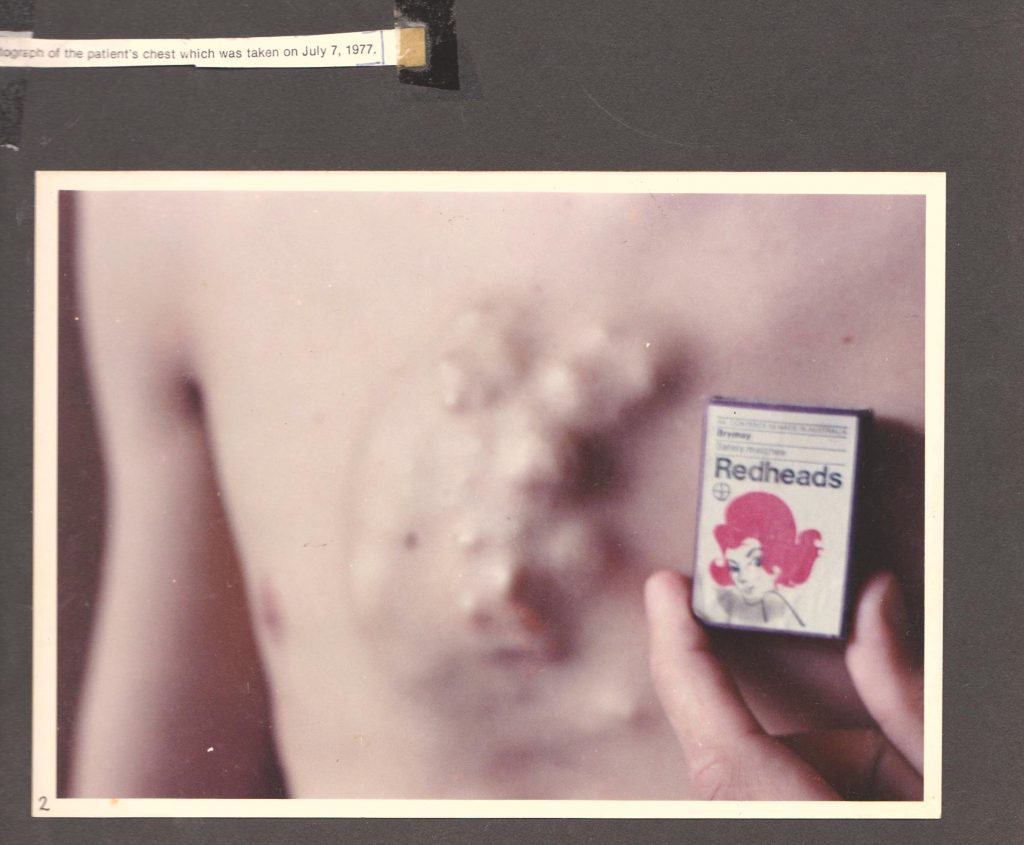 Ian Gawler chest wall - originals taken 7 july 1977