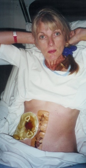 Me after 1st ileostomy and colectomy in 2000