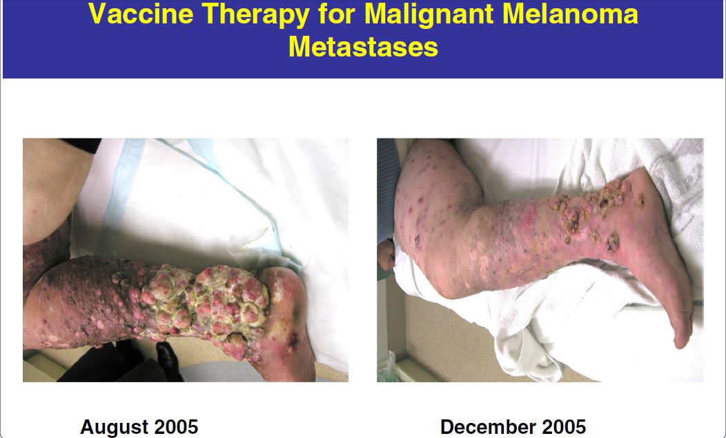 Melanoma vaccines